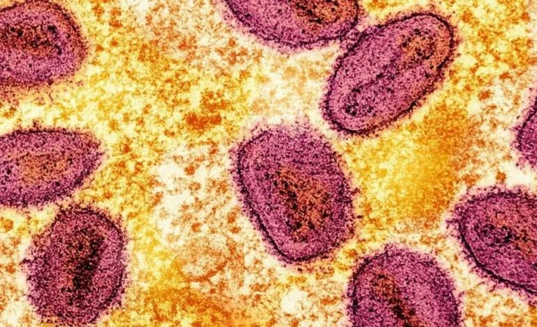 California Reports First US Case of Severe Mpox Strain, But Public Risk Remains Low