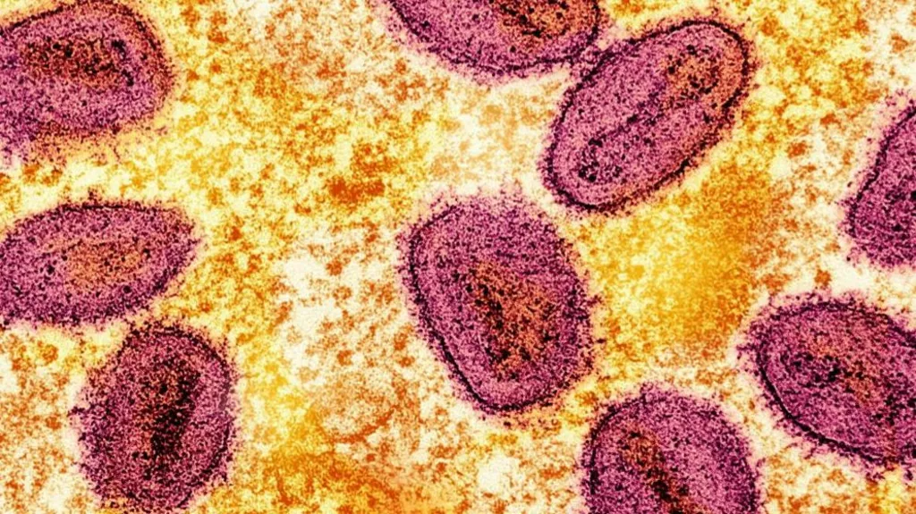 California Reports First US Case of Severe Mpox Strain, But Public Risk Remains Low