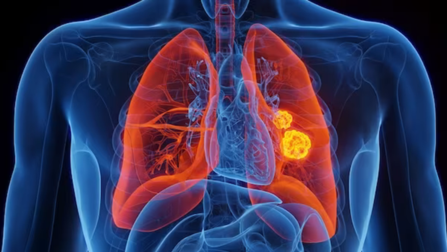 Lung Cancer Survival Rate Sees Significant Improvement, Study Finds