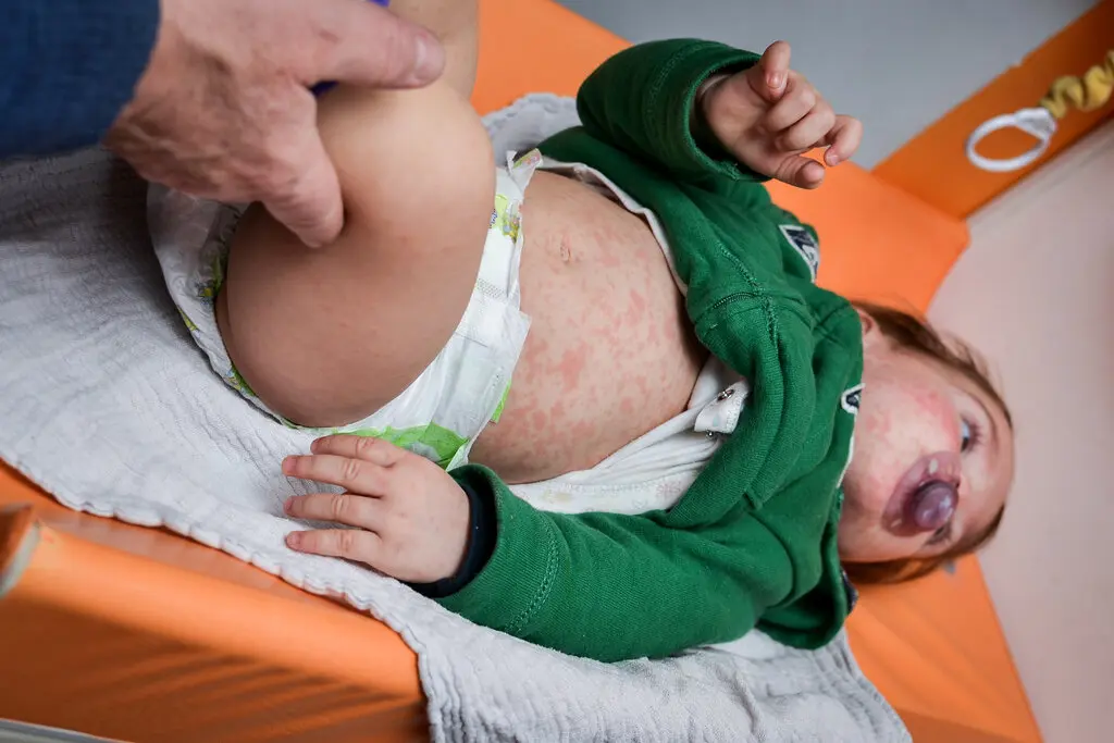 Six Childhood Illnesses We’ve Almost Forgotten, Thanks to Vaccines