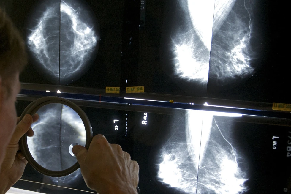 Studies Indicate Some Breast Cancer Patients Can Forego Certain Surgeries