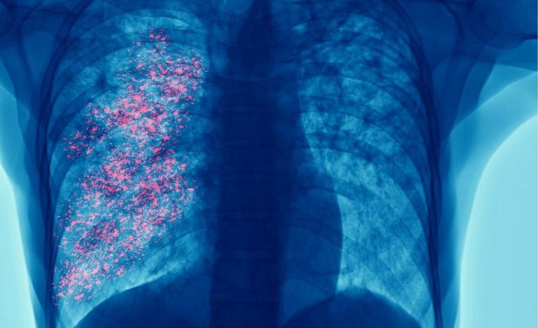 Kansas Faces Record-Breaking Tuberculosis Outbreak in 2024