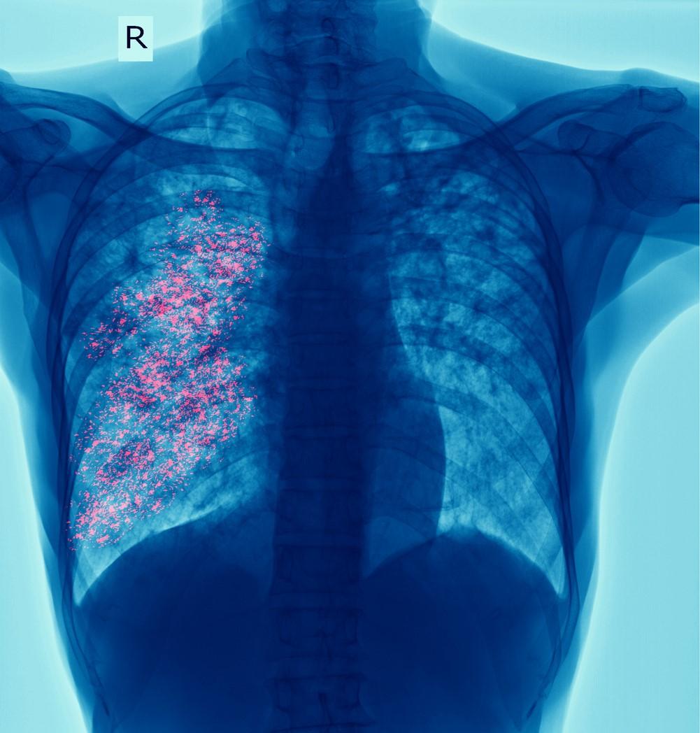 Kansas Faces Record-Breaking Tuberculosis Outbreak in 2024