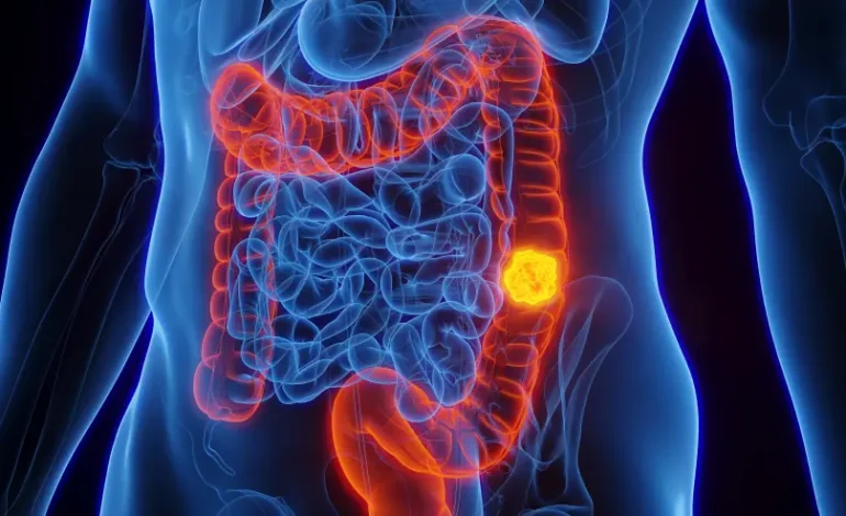 Three Often-Overlooked Side Effects of Colorectal Cancer