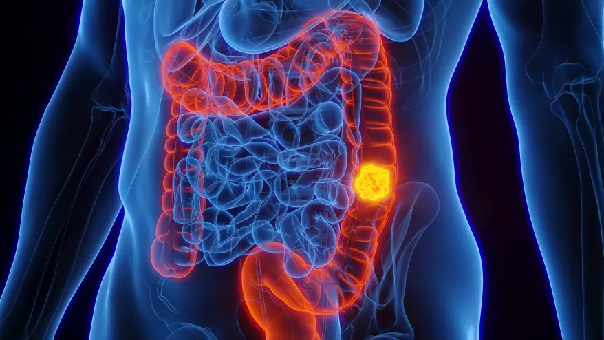 Three Often-Overlooked Side Effects of Colorectal Cancer